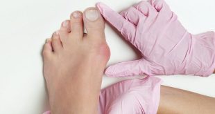 Clever ways to deal with bunions