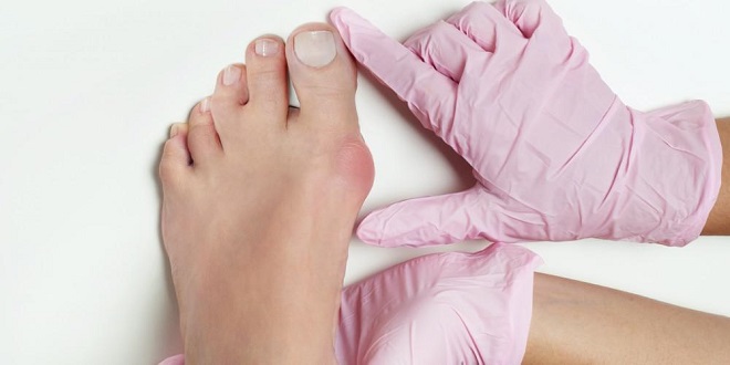 Clever ways to deal with bunions