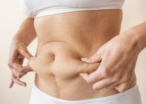 What is A Tummy Tuck and Tummy Tuck Turkey?
