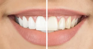 Effective Ways To Keep Your Teeth White