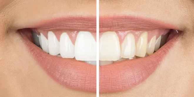Effective Ways To Keep Your Teeth White