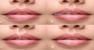Lip Fillers: Enhancing Your Natural Beauty Safely And Effectively