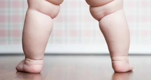 Understanding Cankles: What Causes Cankles and How Can They Affect Your Health and Self-Esteem?