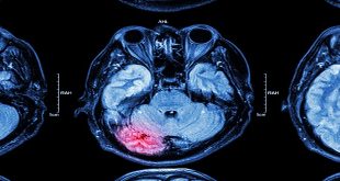 Navigating the VA Claims Process for Traumatic Brain Injury (TBI)