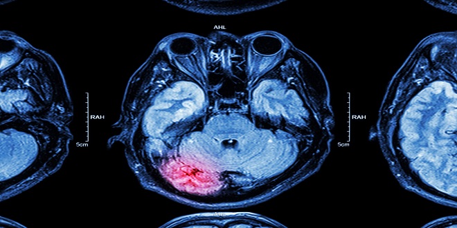 Navigating the VA Claims Process for Traumatic Brain Injury (TBI)