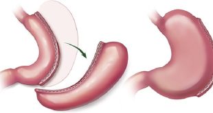 Achieving Success: The Power of Endoscopic Revision for Sleeve Gastrectomy