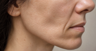 Facial changes after major weight loss showing skin, volume, and contour differences.